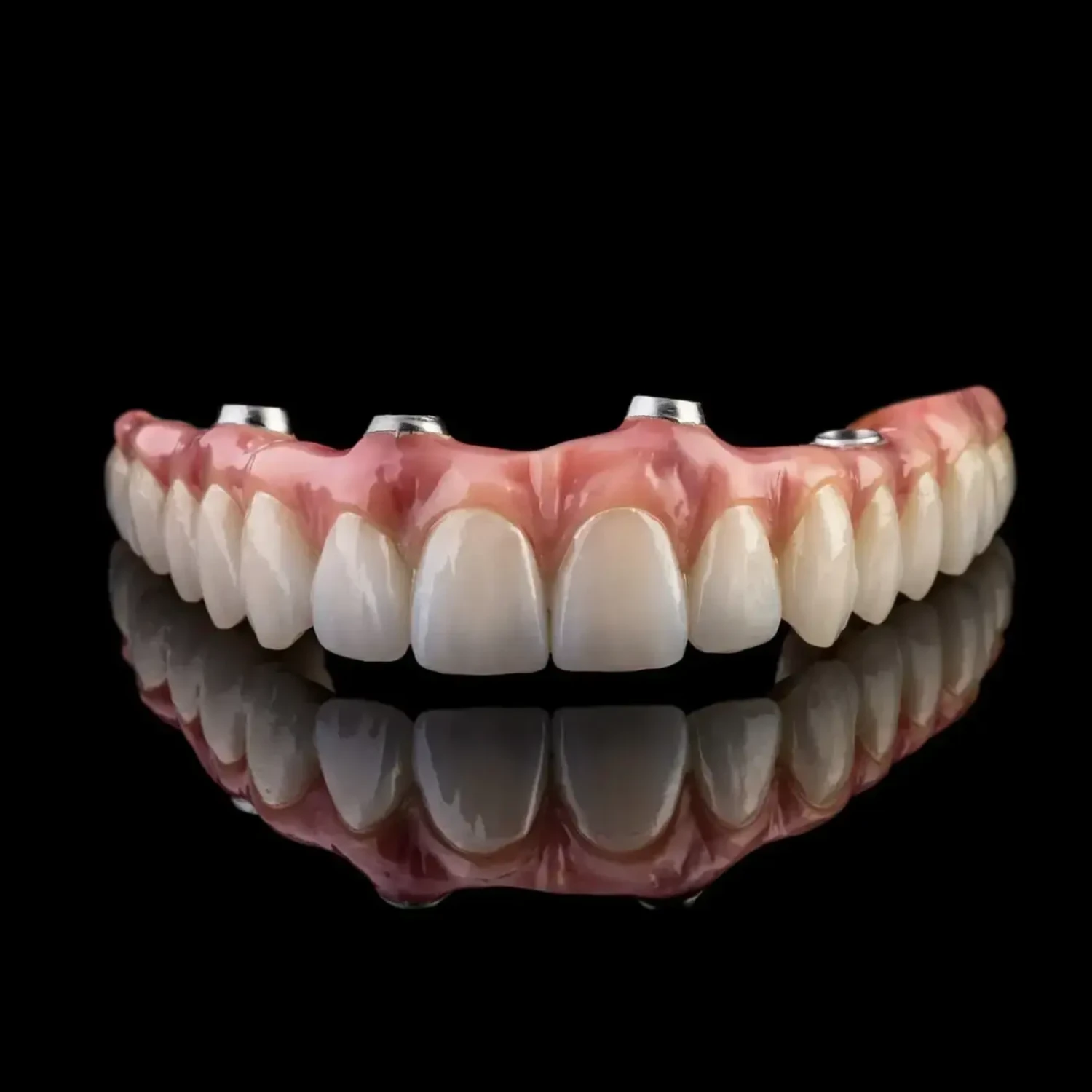 All-on-4 full-arch implant bridge