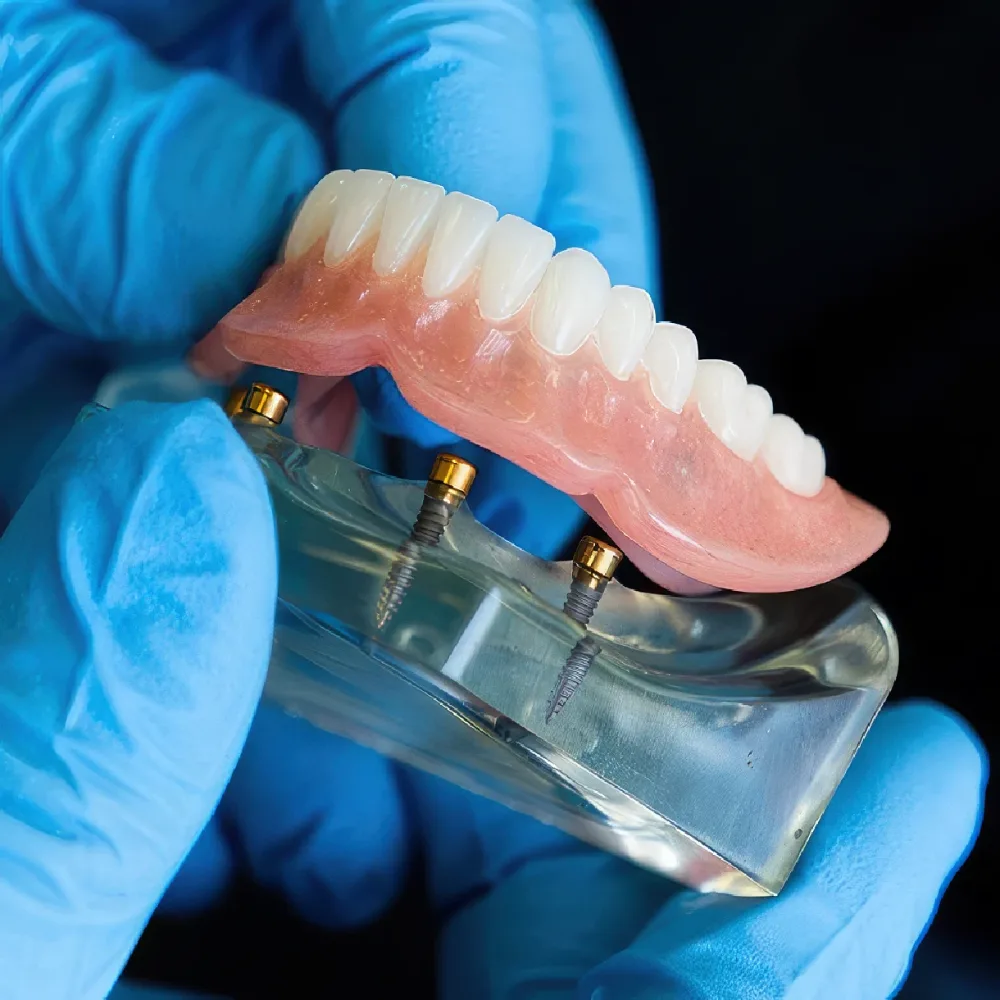 Implant overdenture snapping onto implant attachments