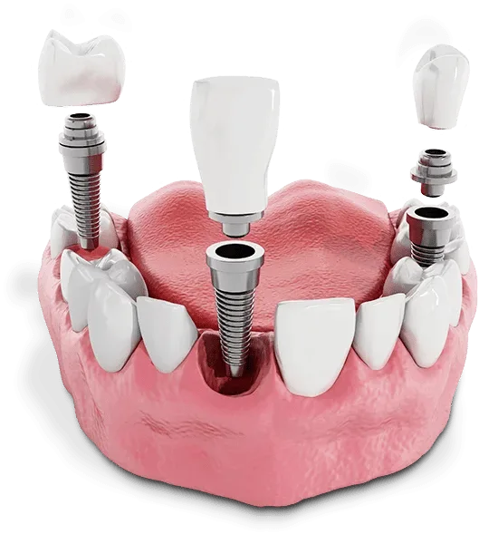 Model of a single dental implant with abutment and crown